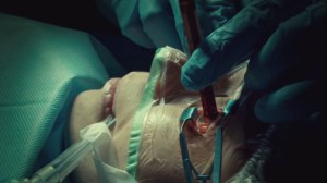 The Weight of This Combination- Doctors extract pencil from Rachel's eye